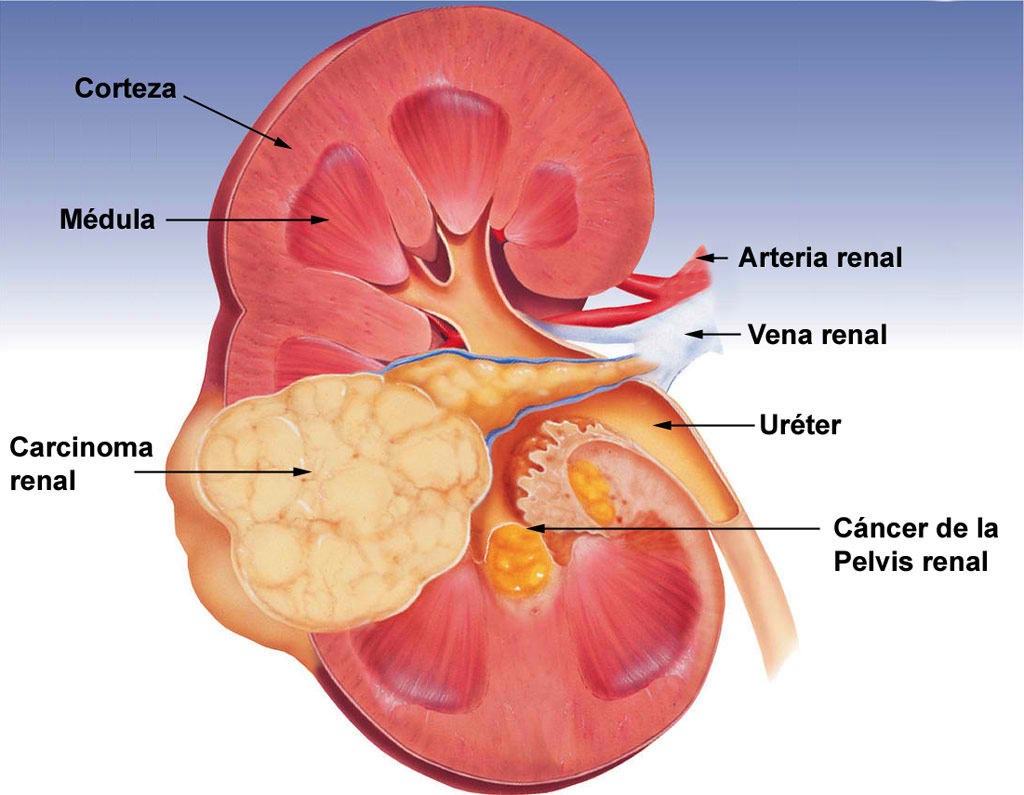 cancer-renal