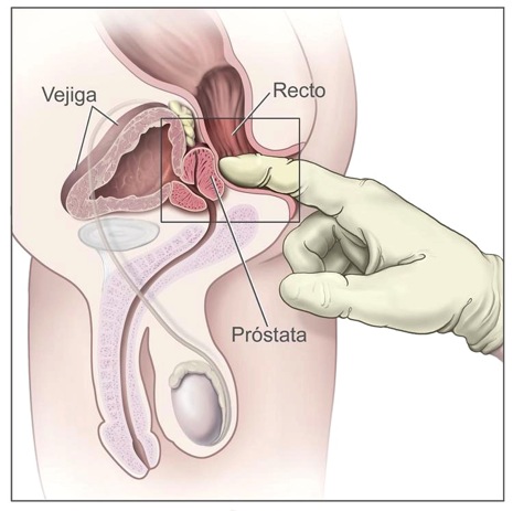 Examen prostata urologo
