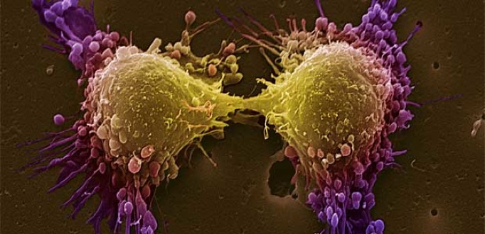 prostatecancer cell